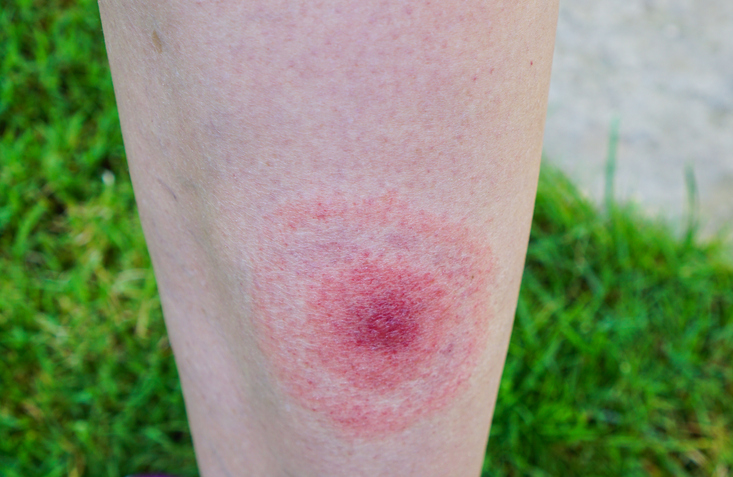 Bullseye rash that may indicate Lyme disease
