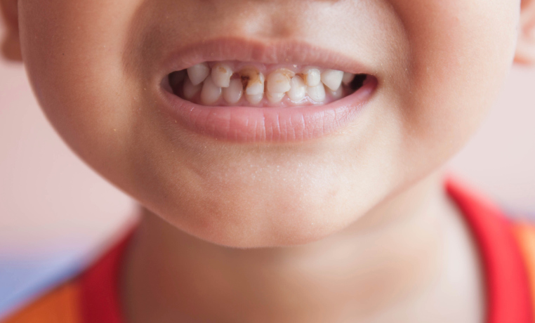 Child with tooth decay