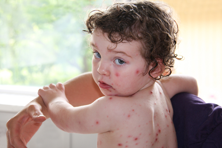 Shingles: The Nasty Relative Of Chickenpox | WDG Public Health