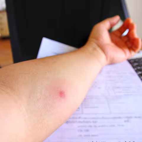 TB skin test spot on arm
