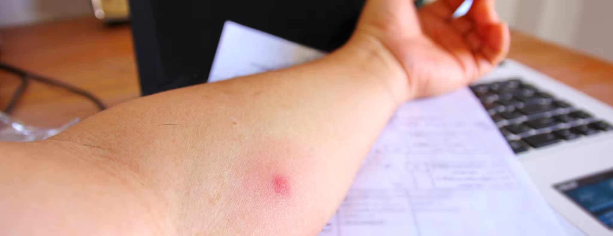 TB skin test spot on arm